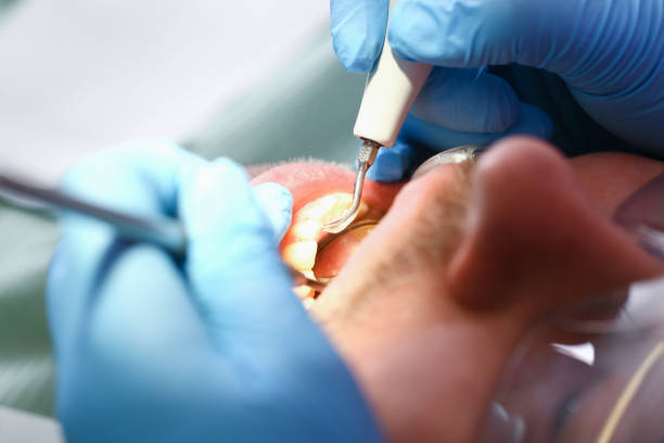 Best Emergency Treatment for Oral Infections in Lodi, CA